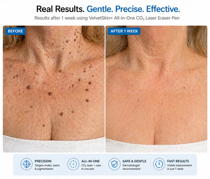 LUMIVO™ All-in-One CO₂ Laser Eraser Pen | Removes Moles, Warts, Skin Flaws & Pigmentation