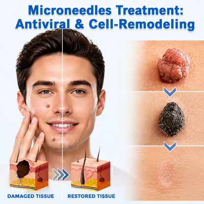 ✨Limited-Time Sale Ends Soon | Lumivo® 2-in-1 Microneedle Hydrocolloid Patches for Moles, Acne, Warts & Skin Tags