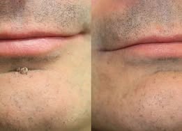 ✨Limited-Time Sale Ends Soon | Lumivo® 2-in-1 Microneedle Hydrocolloid Patches for Moles, Acne, Warts & Skin Tags