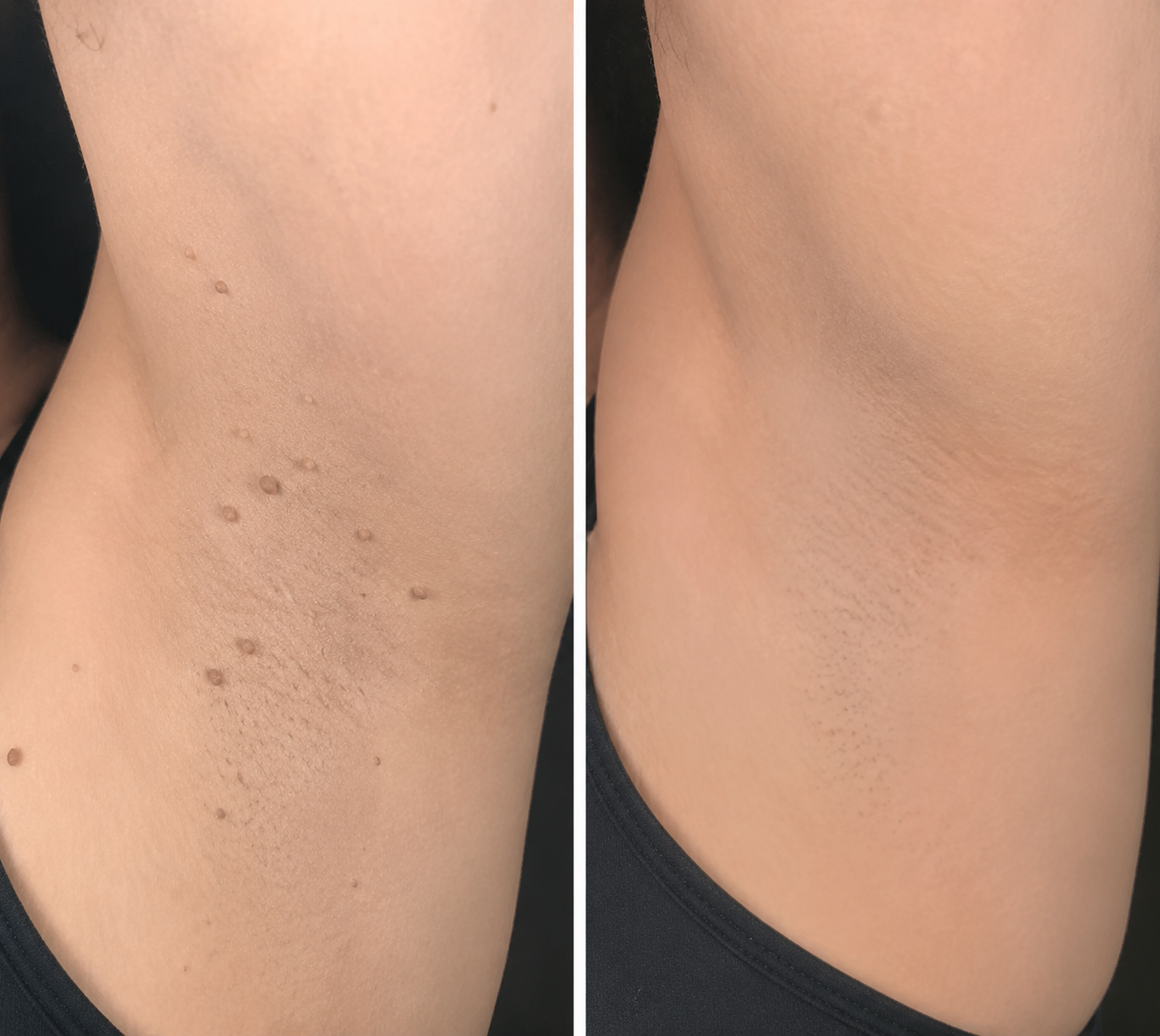 ✨Limited-Time Sale Ends Soon | Lumivo® 2-in-1 Microneedle Hydrocolloid Patches for Moles, Acne, Warts & Skin Tags