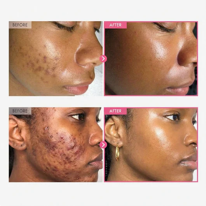 💥Limited Time Sales - 50% OFF💥Arbutin 7% + Tranexamic Acid 4% Cream