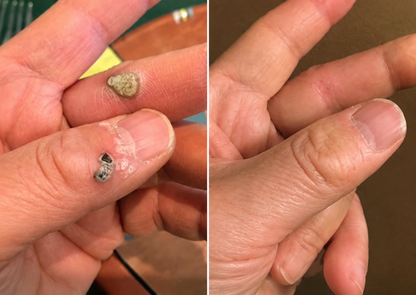 ✨Limited-Time Sale Ends Soon | Lumivo® 2-in-1 Microneedle Hydrocolloid Patches for Moles, Acne, Warts & Skin Tags